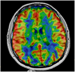 Neuro Imaging MRI