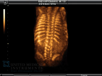 MRI